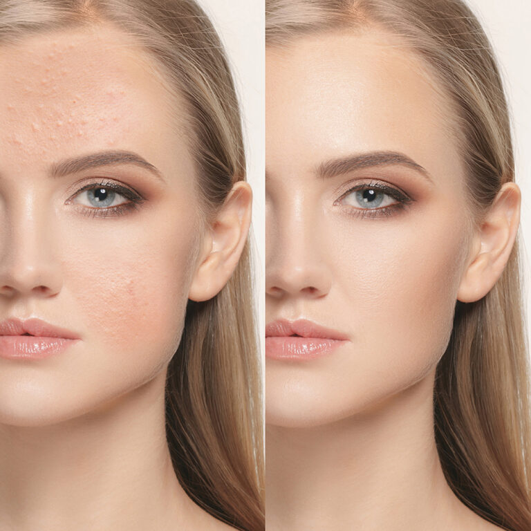 The female face of woman before and after treatment, collage